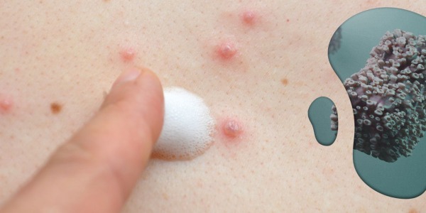 ¿Qué es la Viruela del Mono?